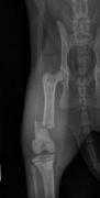 fracture fémur